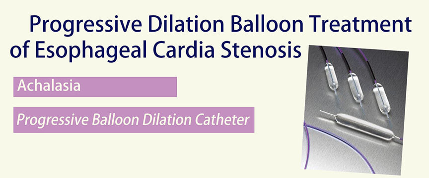 Progressive Dilation Balloon Treatment of Esophageal Cardia Stenosis