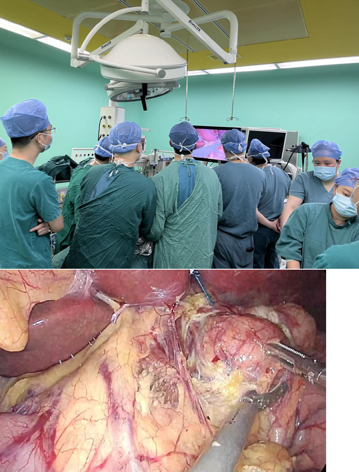Successful resection of the complex encircling giant leiomyoma of esophagus by Endoscopic and Laparoscopic Combined Treatment